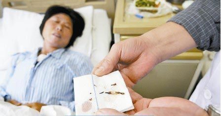 通過手術(shù)取出的針?！　∩虉笥浾?
