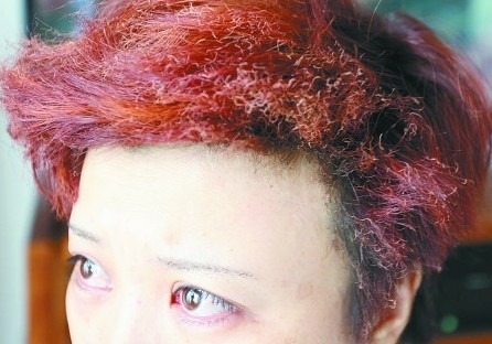 張女士的頭發(fā)、眉毛被燒。