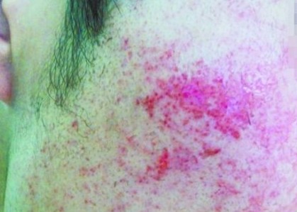 屈臣氏購(gòu)薇婷脫毛膏致面部過敏 布滿紅疙瘩