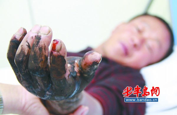 鄒先生的左手被蛇咬傷后明顯腫脹。