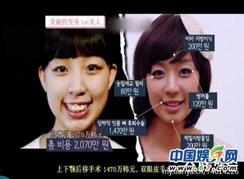 多圖劇透韓國整容節(jié)目《LET 美人》近幾期，最愛小V臉，人瘦就能美