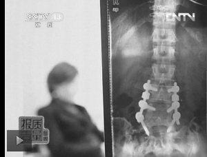 圖1：教練按壓導(dǎo)致學(xué)員腰椎間盤突出。（央視截屏）