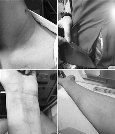 南航一空姐被打后，稱(chēng)其手部淤青，身上有多處撓痕。
