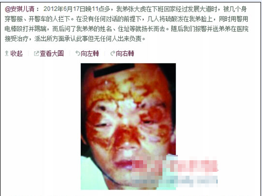 張大虎的姐姐將弟弟面部燒傷一事發(fā)上微博，引發(fā)網(wǎng)友廣泛關(guān)注。